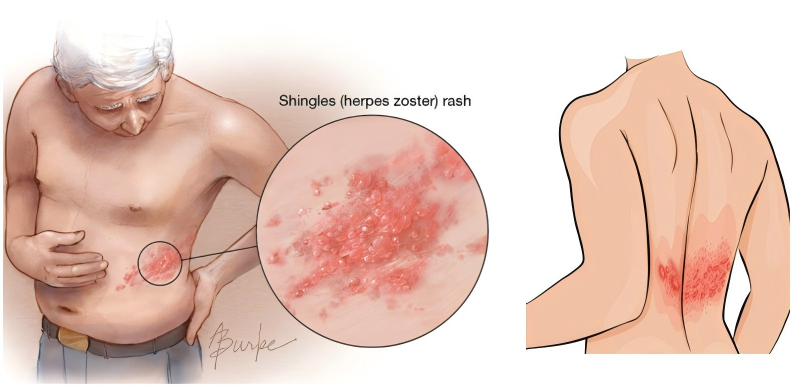 团队发表带状疱疹mRNA疫苗研究进展